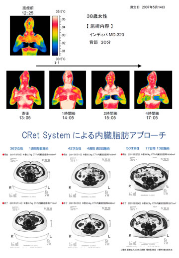 インディバの効果